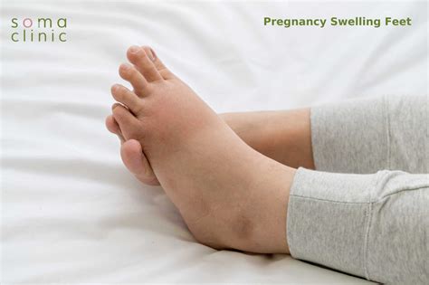 Postpartum Water Retention – 3 Effective Natural Treatments