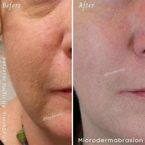 Microdermabrasion | LiLyDermis | Calgary