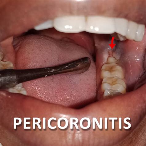 Pericoronitis