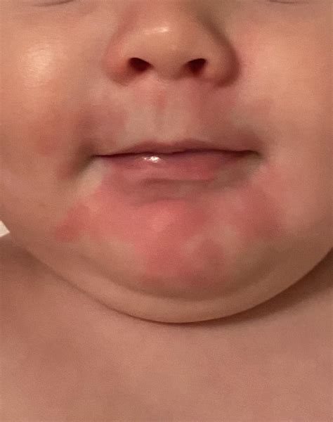 Drool rash or food allergy? He just tried yogurt for the first time ...