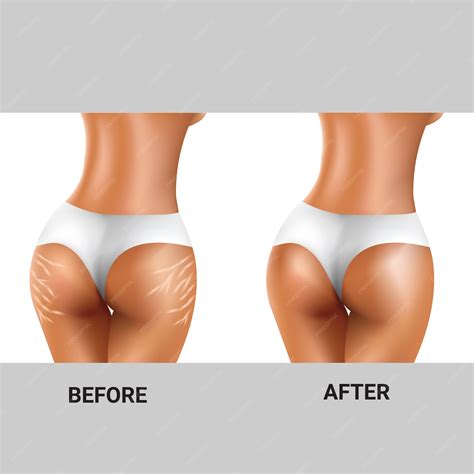 Stretch Marks On Butt