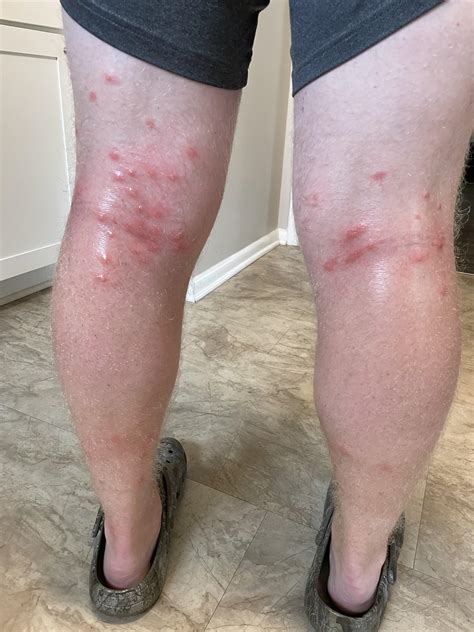 What are these? Bug bites (mosquito?), rash, allergic reaction, poison ...