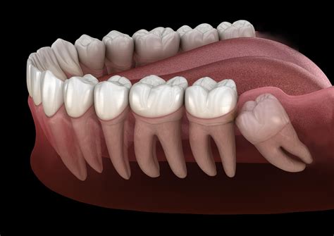 Impacted Wisdom Teeth - Flowood, MS
