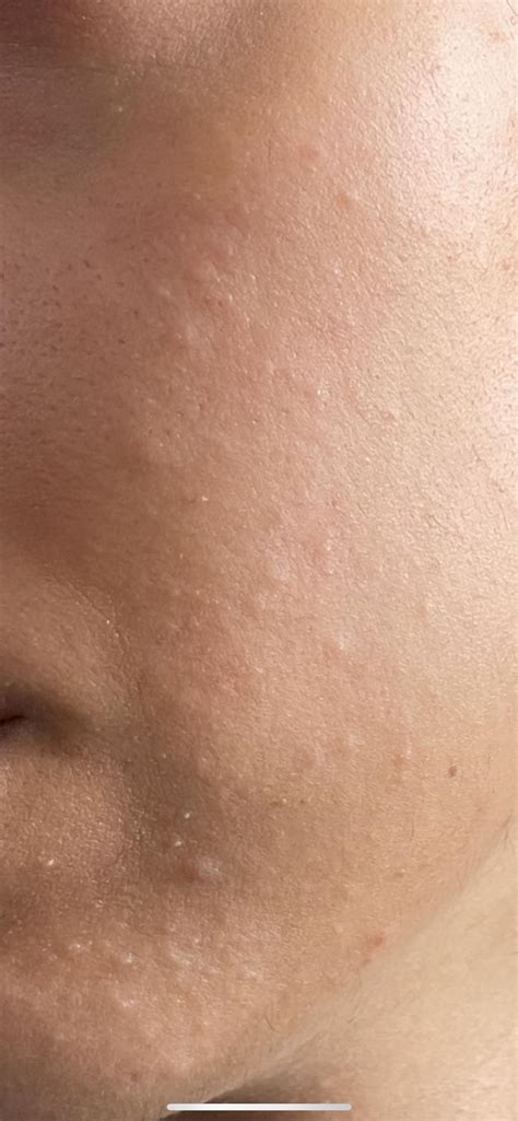 Comedonal Acne Natural Treatment