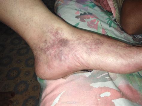 Ask a Dermatologist Online for Dark Spots On Feet