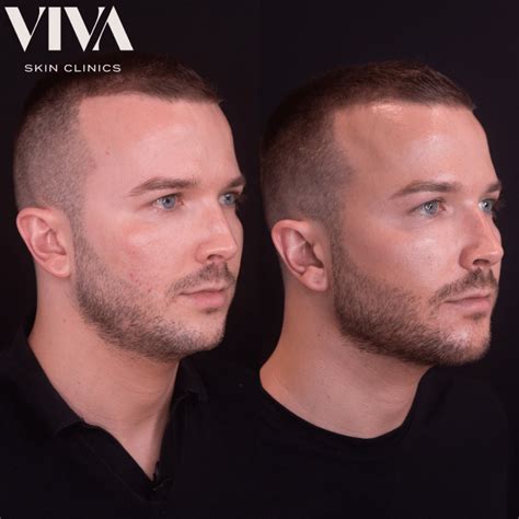 Men's Cheek Filler - Men's Cheekbone Filler from £375