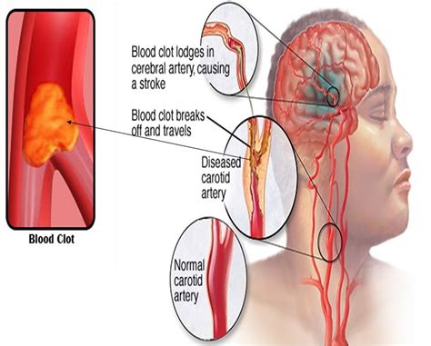 Embolic stroke - Embolic Ischemic Stroke Causes, Symptoms & Treatment