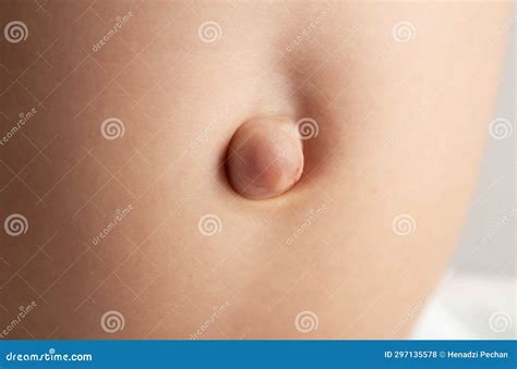 Umbilical Hernia. Male Belly With A Large Bulging Navel Close Up Royalty-Free Stock Image ...