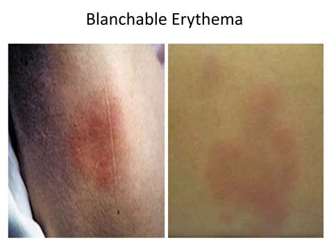 Physiotherapy Management for Wound Ulcers Rahul.AP BPT,MPT (CRD&ICU ...