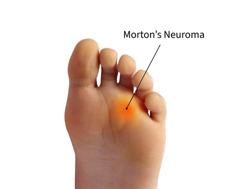 Morton’s Neuroma | Foot Lab Podiatry