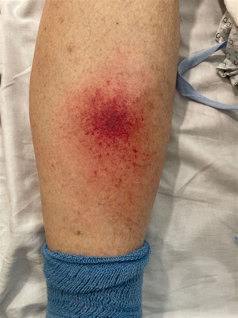 Pseudomonas aeruginosa–Associated Ecthyma Gangrenosum: A Classic ...