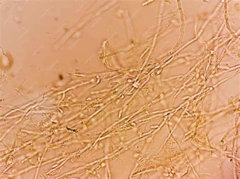 Premium Photo | Pseudohyphae and budding yeast cells in patient urine ...