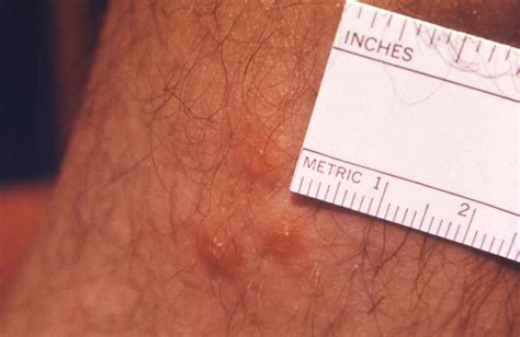 Chiggers Bite Pics at Mary Bilbo blog