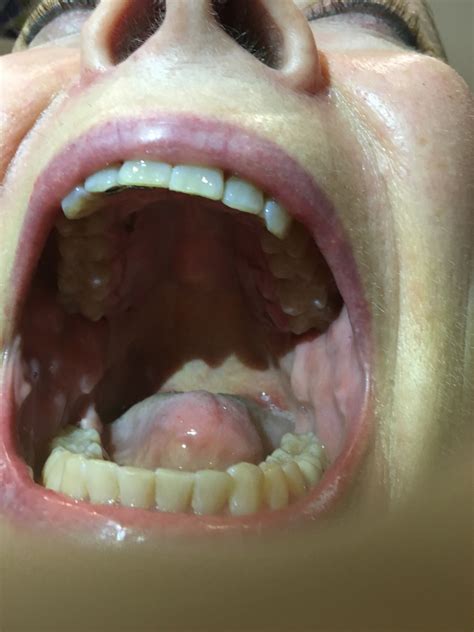 Food Getting Stuck In Torus Mandibularis Mouth