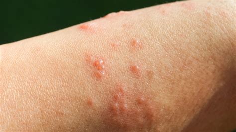 Shingles Symptoms On Legs