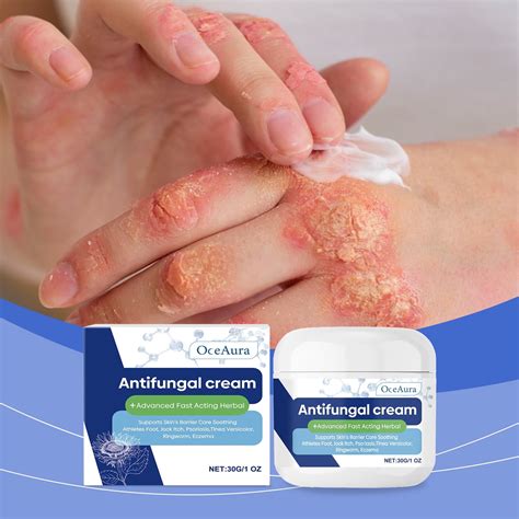 Antifungal Cream for Jock Itch: Anti Fungal Cream for Itchy Skin Relief ...