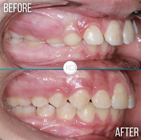 Discover How Braces Effectively Correct Overbites