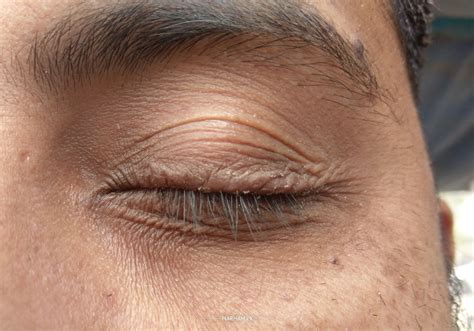 Ask a Dermatologist Online for Dryness On Upper Eyelid Of Both Eyes And In