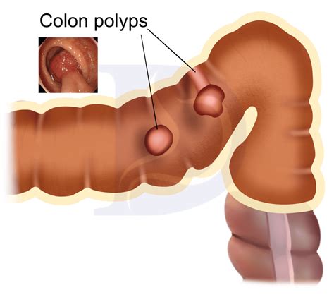 Bowel Polyps Photos