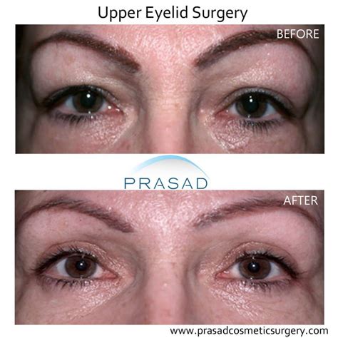 Hooded Eyelid Surgery: Results and Recovery