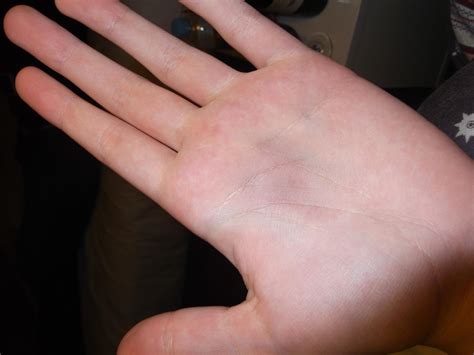 Burst Blood Vessel In Finger Images Blood Blisters: Causes, Diagnosis,