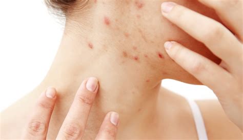 Should You Be Using Hyaluronic Acid for Acne? | 100% PURE