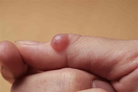 Sore Bump On My Knuckle