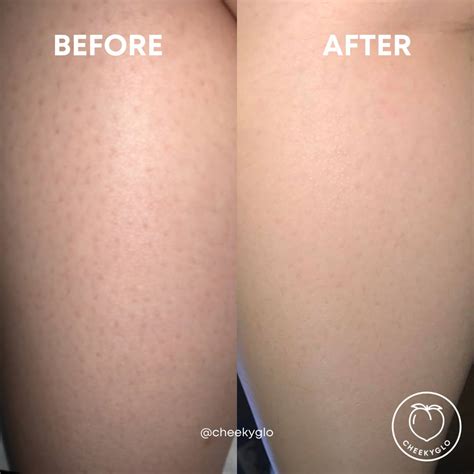 Top 105+ Pictures Keratosis Pilaris Amlactin Before And After Pictures Stunning