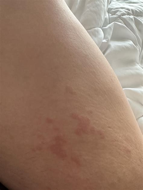 Rashes on both inner thighs : r/Dermatology