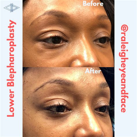 Raleigh Eye and Face Plastic Surgery - Raleigh Eye and Face Plastic Surgery - Serving Raleigh ...