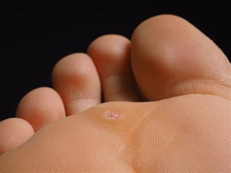 Removal Of Plantar Wart On Foot Sale | emergencydentistry.com