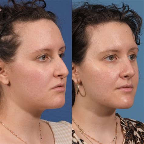 Septoplasty Before & After #20