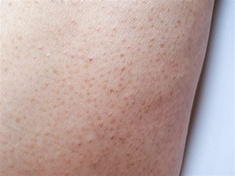 Chicken Skin (keratosis Pilaris): Causes, Treatment, And, 41% OFF