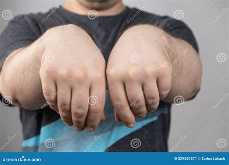 Wrist Ganglion Cyst Disease , Ganglion Cyst , A Fluid-filled Lump Under The Skin , Pain Hand ...