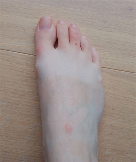 Extremely itchy single blisters on feet... : r/Dyshidrosis
