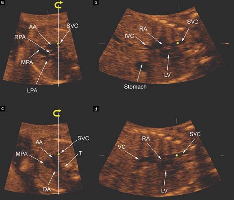 The 'spin' technique: a new method for examination of the fetal outflow ...