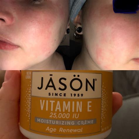 [Product Question] Anyone know why Jason Vitamin E cream did this to me ...