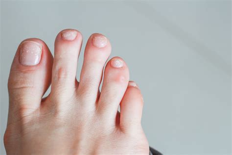 Causes Of White Spots On Your Toenails – My FootDr