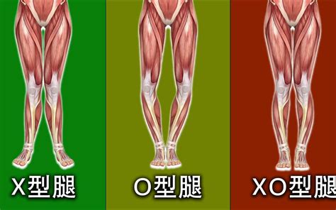 X/O/XO型腿矫正合集，腿型矫正必看 - 哔哩哔哩