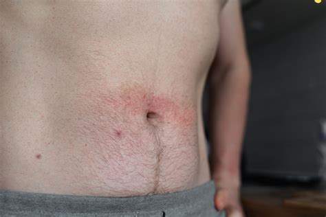 Understanding eczema: definition, symptoms, causes, and treatments