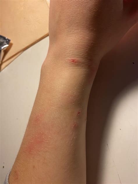 Got bitten by an akita three hours ago. What should I do? : r/medical ...