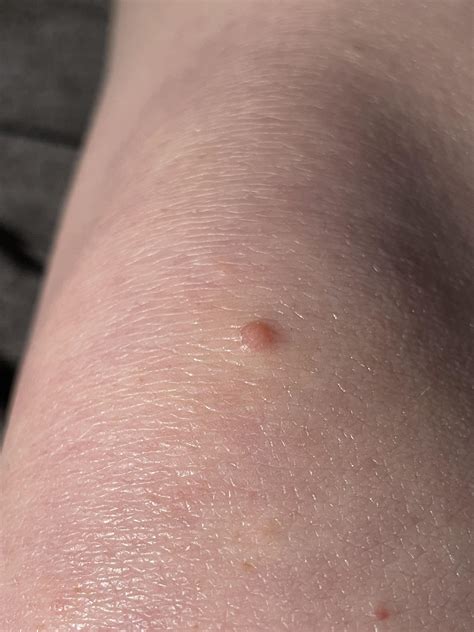 I’ve had this bump on my knee for over a month. Does it look like a wart, or something else? It ...