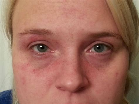 Itchy Painful Rash Around Eyes at Julian Syme blog
