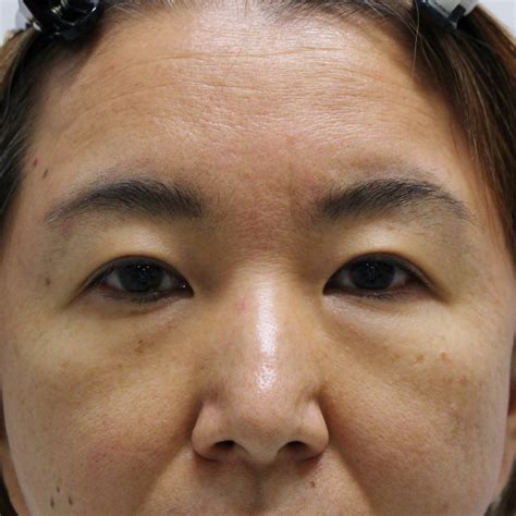 ☆14 ★161 49歳女性 経結膜脱脂術+マイクロCRF（目の下・中顔面） 眉下切開 半年後 - シンシア総院長ブログ～Sincerely ...