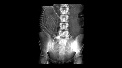 Digital X Rays Pregnancy