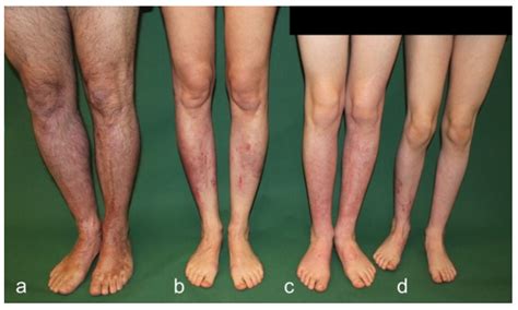 Skin Healing of Deep Second Degree Burn Injuries in Four Individuals ...