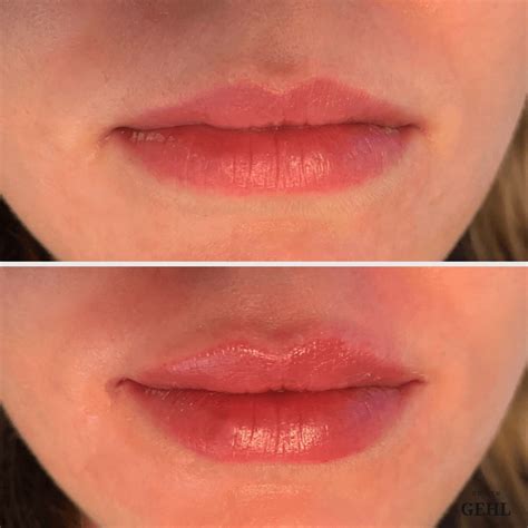 Botox® Lip Flip | Lippen | Ordination Dr. Benjamin Gehl | Lippenprodukte, Lippen permanent make ...