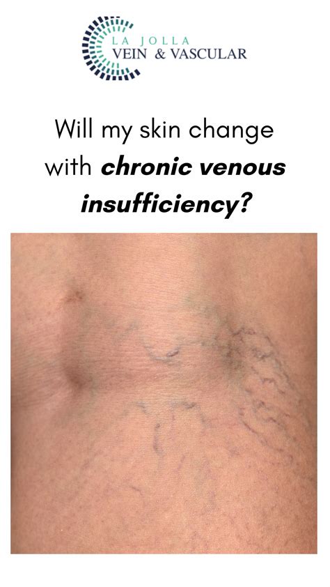 Will My Skin Change with Chronic Venous Insufficiency?