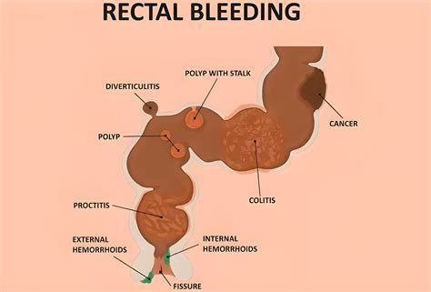 Rectal Bleeding: Causes, Symptoms & When to See a Doctor