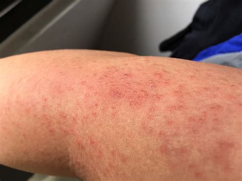 Itchy Leg Rash